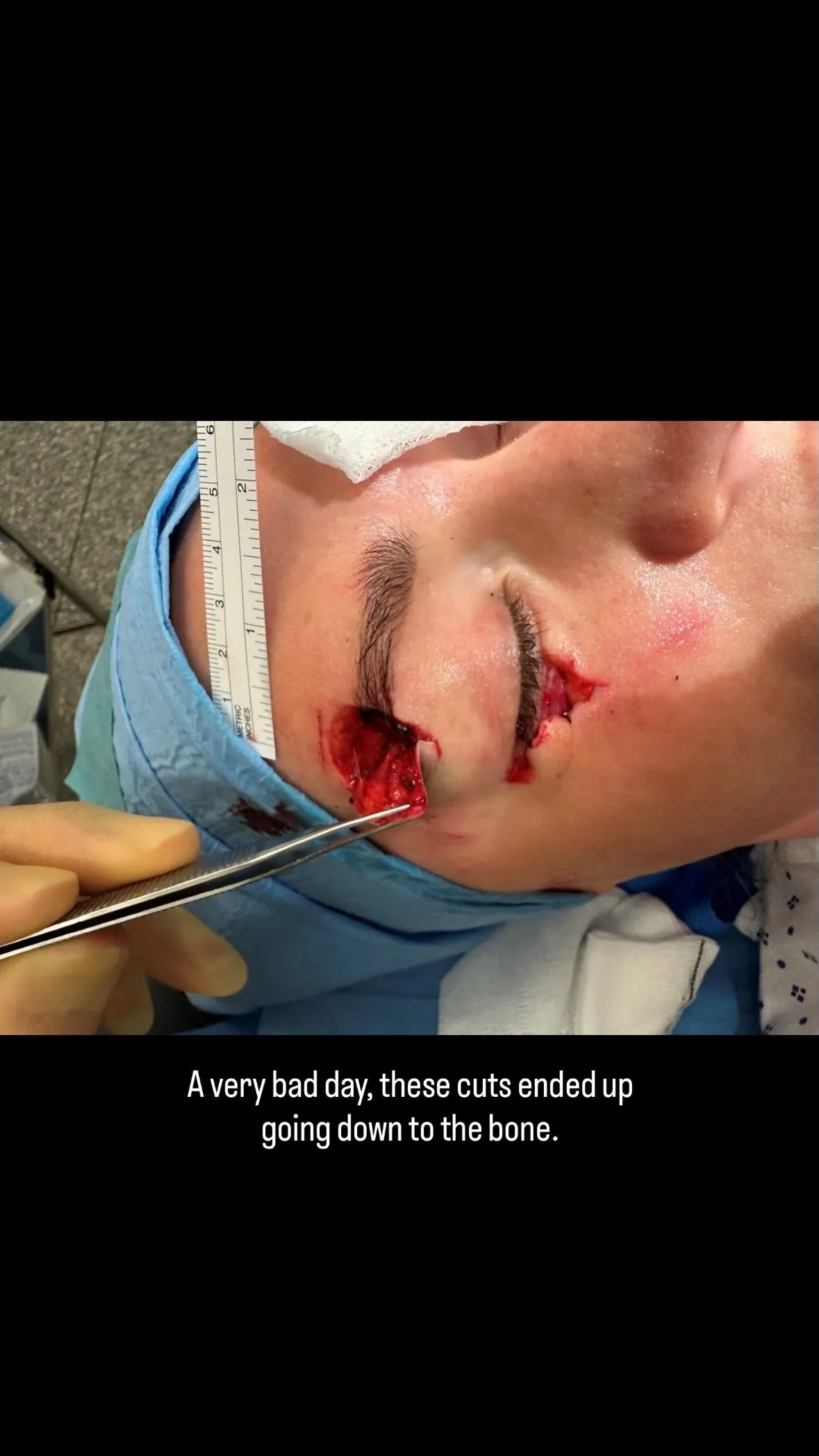 Advertencia gráfica: Laura Woods muestra lesiones faciales tras accidente en vacaciones
